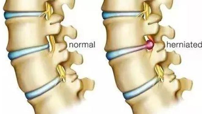 澳门威斯尼斯wns675入口瑜伽教练因长期教习瑜伽导致腰椎间盘突出医生：严重点会(图4)