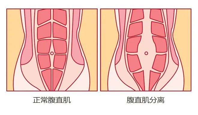 澳门威斯尼斯wns675入口漏尿、松弛、肚子大……别再忍！这个修复方法在家就能做(图8)